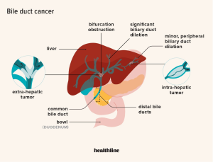 Bile Imbalance Liver Cancer: Key Findings and Implications